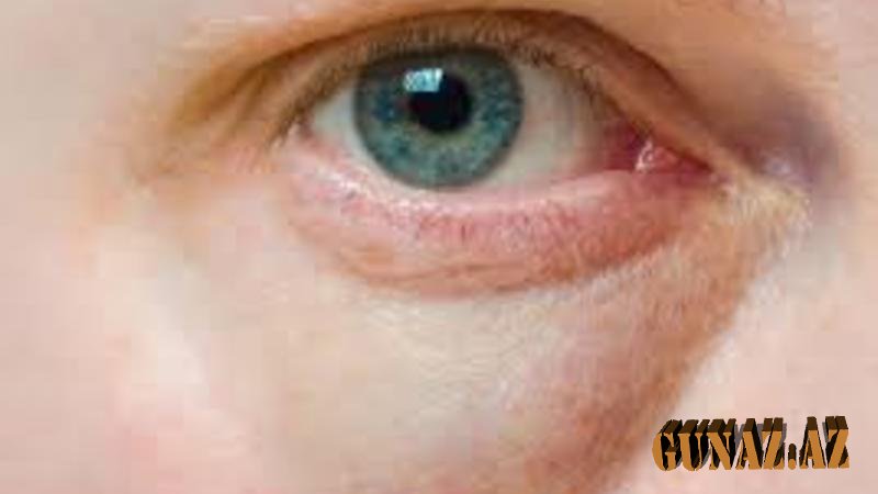 Allergik göz xəstəliklərinin sayı artıb