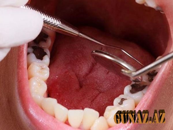 Dişlərin tez çürüməsinə səbəb olan 10 QİDA - SİYAHI