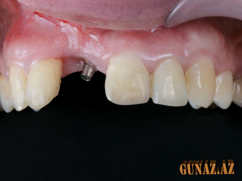 Kimlərə implant diş əkdirmək olmaz? – Qadağa siyahısı