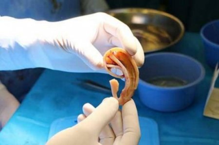 Ananın qabırğa sümüklərindən oğlu üçün qulaq hazırlandı - DÜNYADA İLK - VİDEO