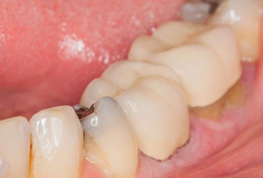 Xarab dişlər bu ağır xəstəliyin riskini artırır