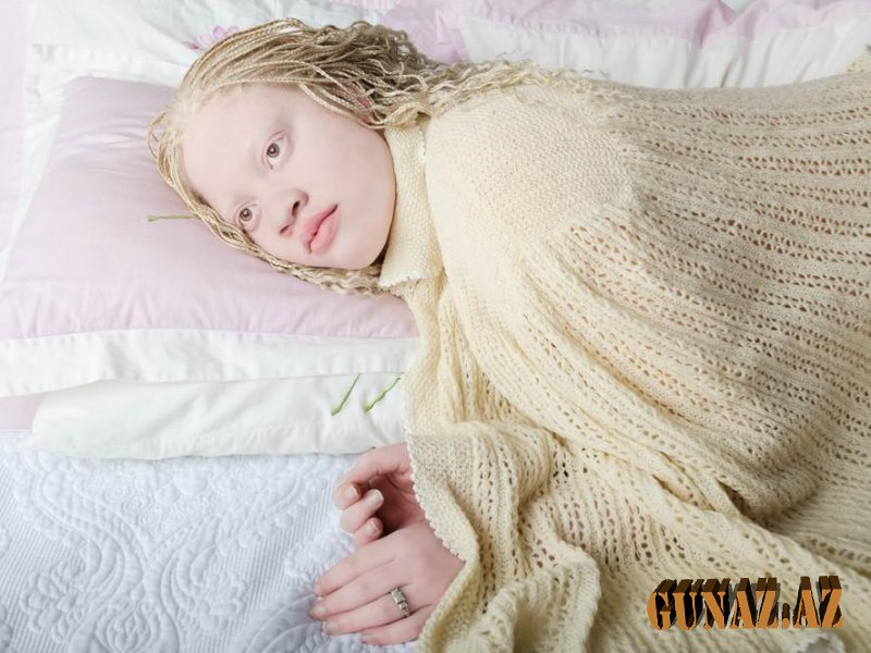 Albinos insanlar xəstə sayılır?