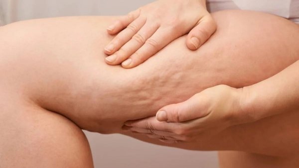 Selülit kimi görünən "lipedema" nədir?
